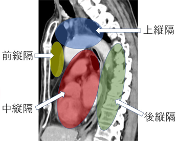縦隔腫瘍イメージ図